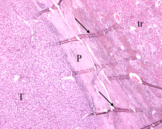 Carcinoma a Cellule chiare Carcinoma a Cellule chiare